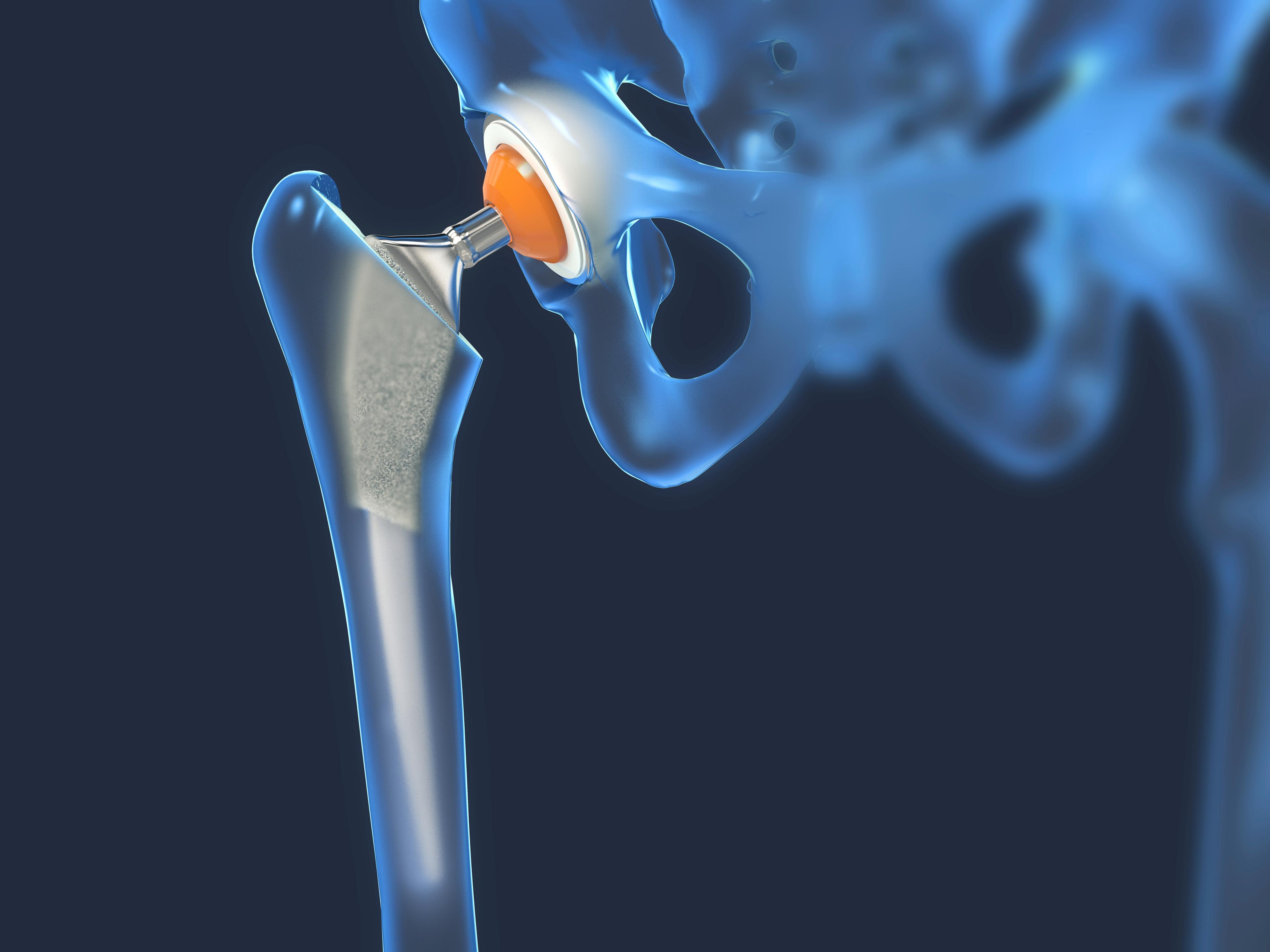 Hip replacement-1155266197.jpg