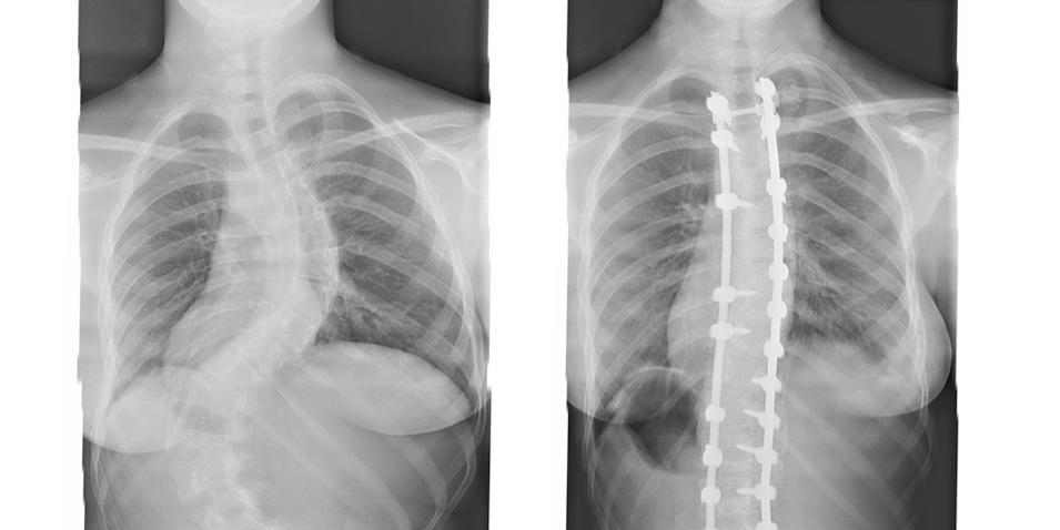 Scoliosis Centre The Portland Hospital (general scoliosis scan).jpg